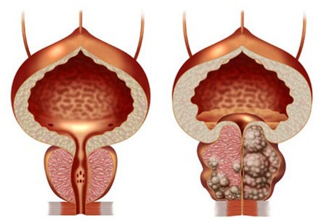 健康的前列腺和前列腺腺瘤
